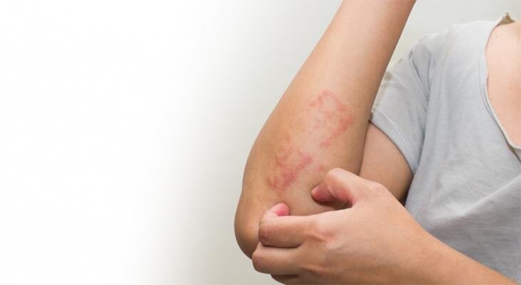 Атопическое воспаление кожи или дерматит